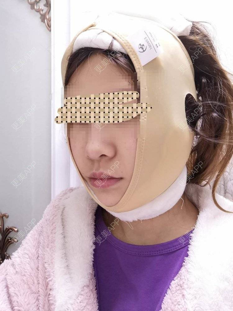 更美 - 蓝涵涵的拉皮经验 | 拉皮 | 广州