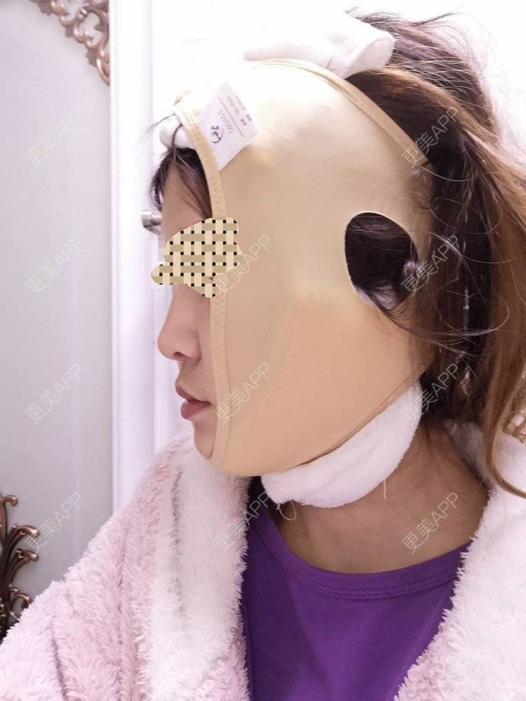更美 - 蓝涵涵的拉皮经验 | 拉皮 | 广州