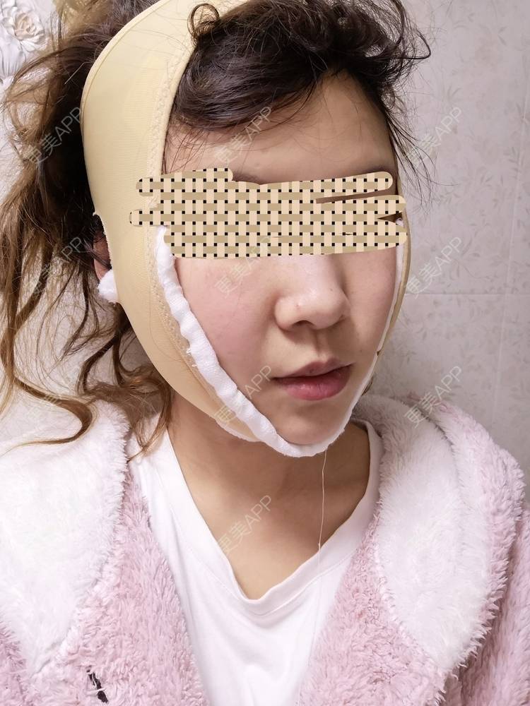 更美 - 蓝涵涵的拉皮经验 | 拉皮 | 广州