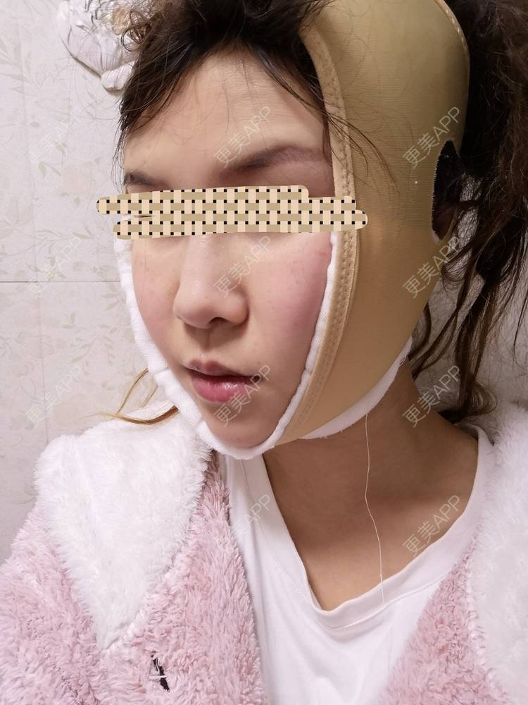 更美 - 蓝涵涵的拉皮经验 | 拉皮 | 广州