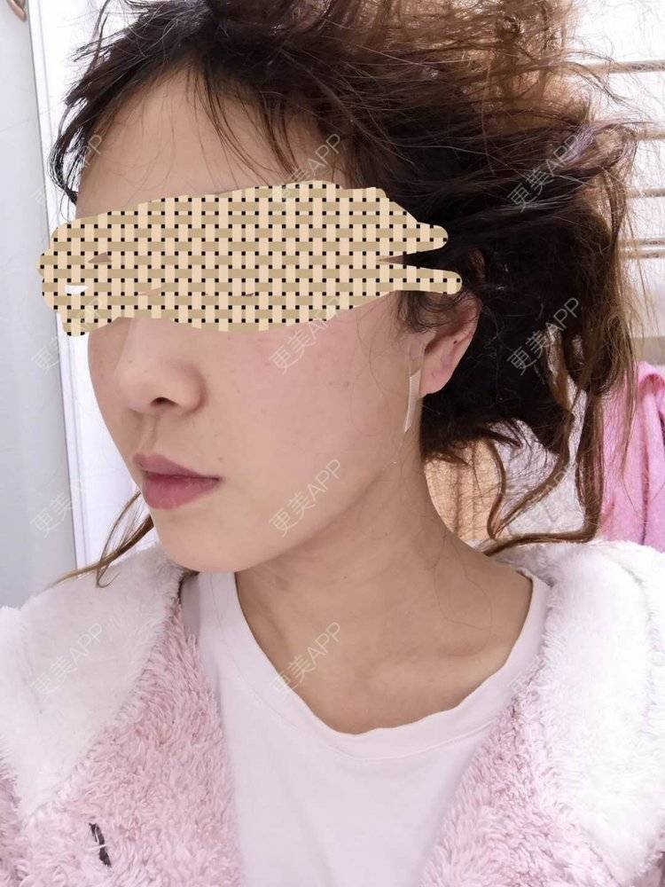 更美 - 蓝涵涵的拉皮经验 | 拉皮 | 广州
