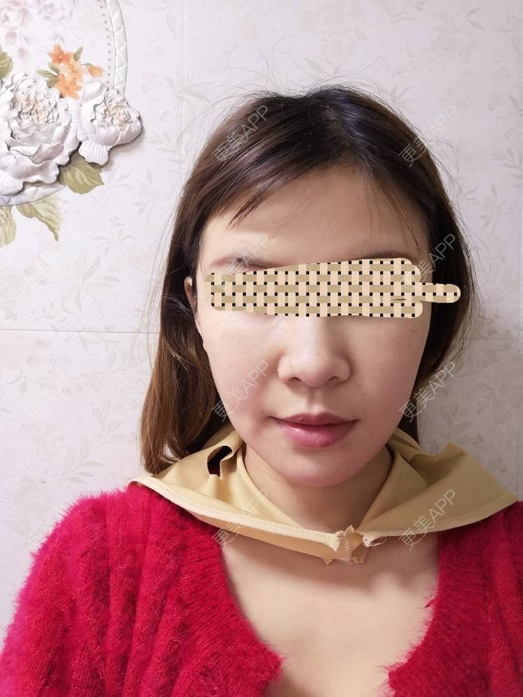 更美 - 蓝涵涵的拉皮经验 | 拉皮 | 广州