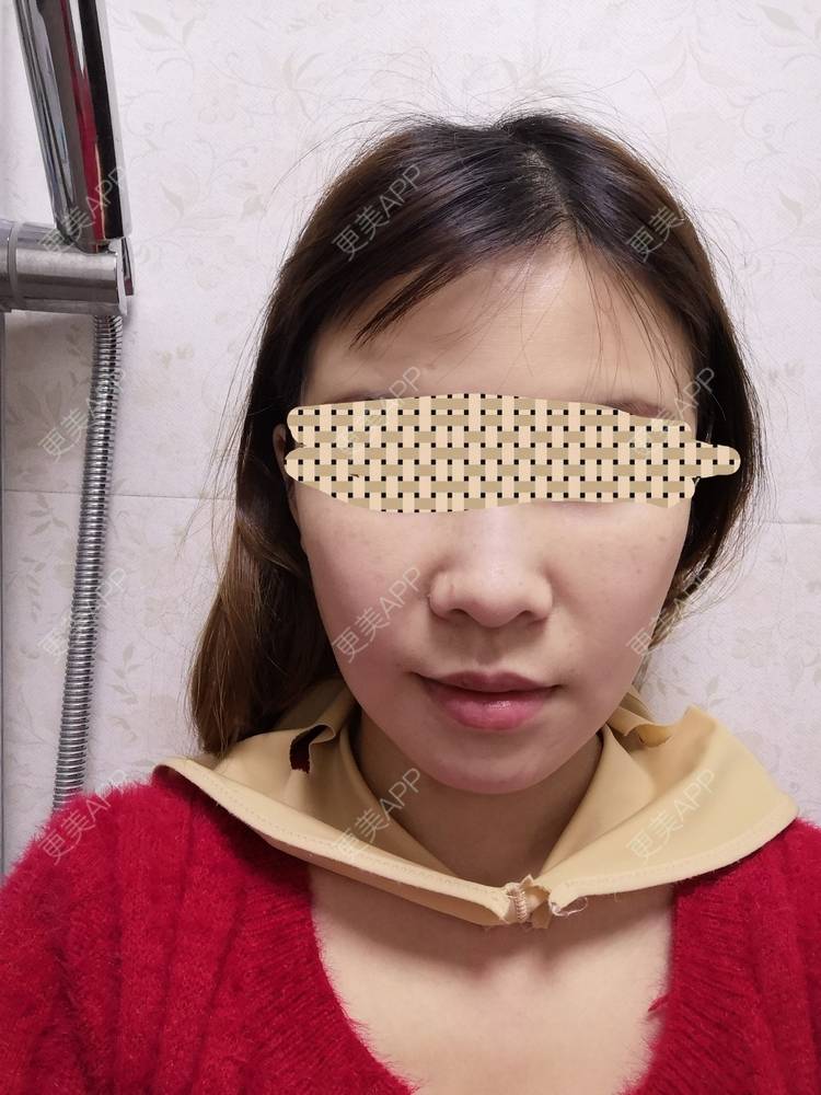 更美 - 蓝涵涵的拉皮经验 | 拉皮 | 广州