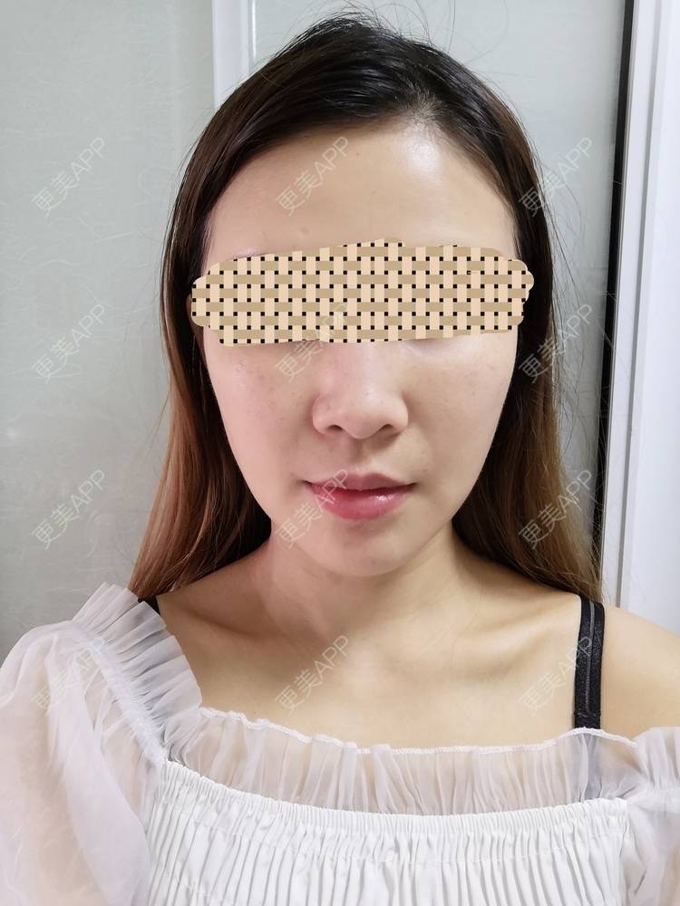 更美 - 蓝涵涵的拉皮经验 | 拉皮 | 广州