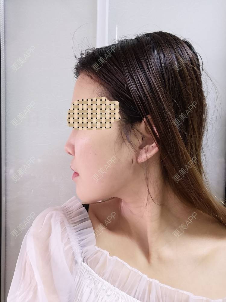 更美 - 蓝涵涵的拉皮经验 | 拉皮 | 广州