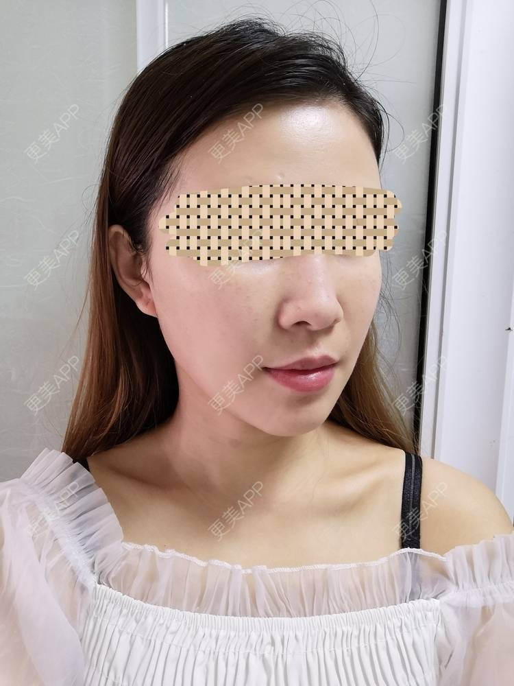 更美 - 蓝涵涵的拉皮经验 | 拉皮 | 广州