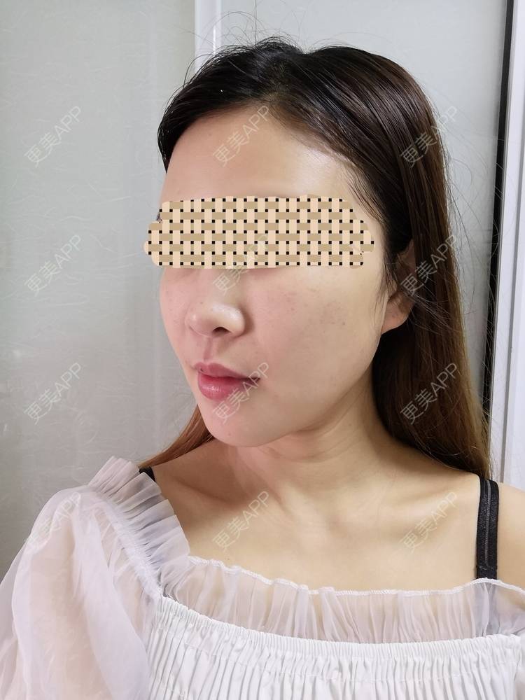 更美 - 蓝涵涵的拉皮经验 | 拉皮 | 广州