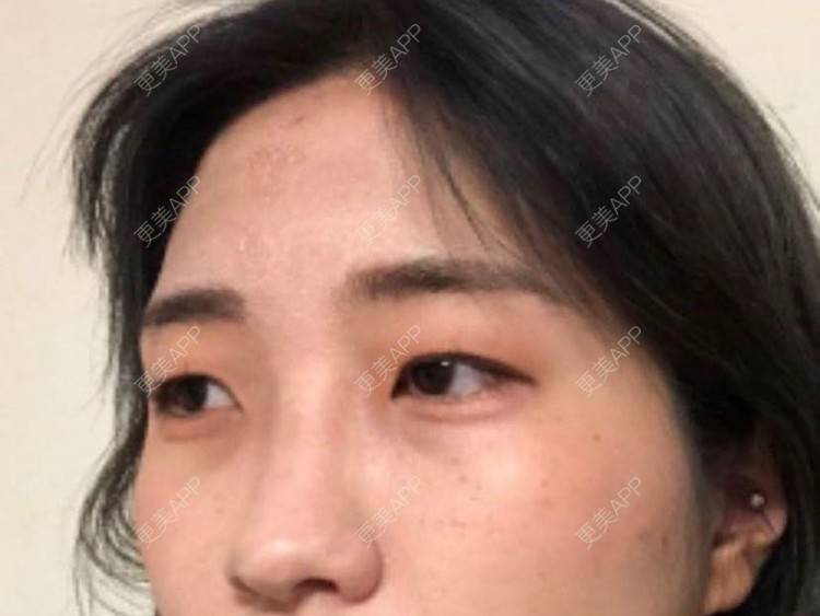 更美 - 〆灵魂纯净如水 气气的胶原蛋白淡化黑眼圈经验 | 胶原蛋白淡化黑眼圈 | 胶原蛋白丰泪沟 | 北京