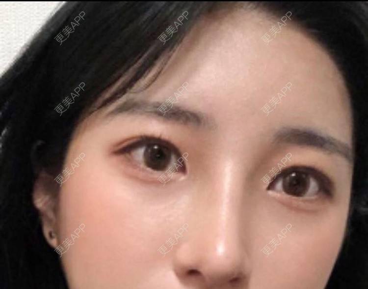 更美 - 〆灵魂纯净如水 气气的胶原蛋白淡化黑眼圈经验 | 胶原蛋白淡化黑眼圈 | 胶原蛋白丰泪沟 | 北京