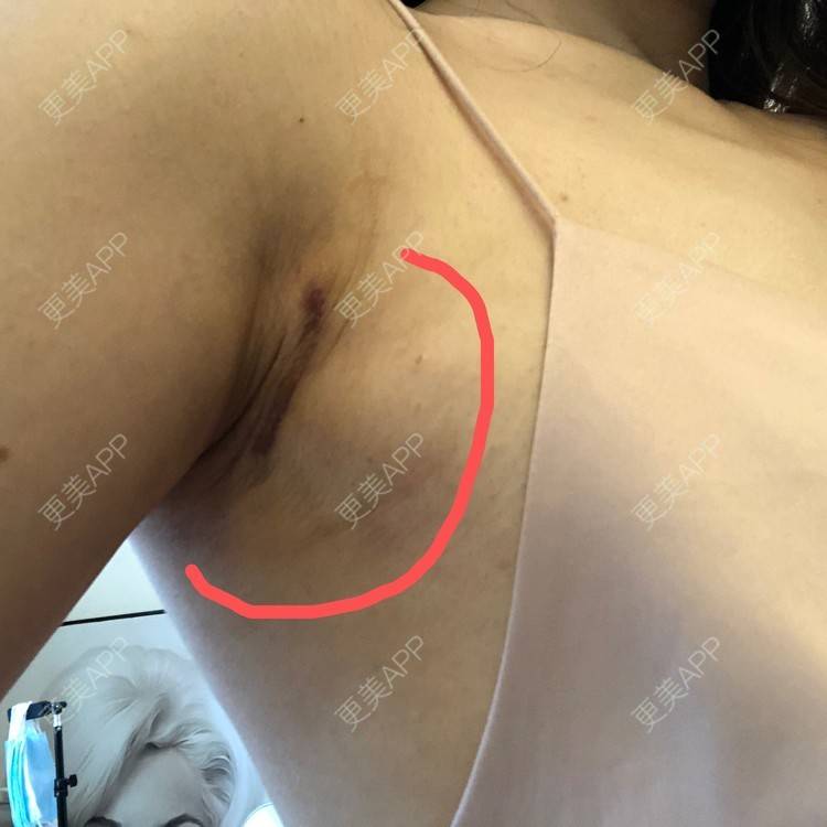 更美 - 幼熙baby的吸脂去副乳经验 | 吸脂去副乳 | 深圳