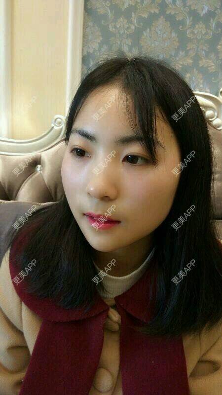 更美 - 更美用户tjHPvupXhN的玻尿酸下巴经验 | 硅胶垫下巴 | 膨体垫下巴 | 缩下巴 | 玻尿酸下巴 | 成都