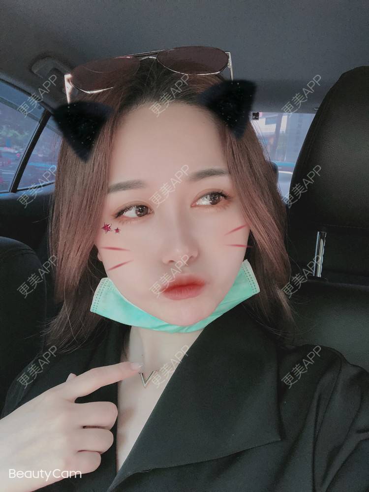 更美 - 甜心泡芙的双眼皮修复经验 | 双眼皮 | 开内眼角 | 双眼皮修复 | 全切双眼皮 | 重庆