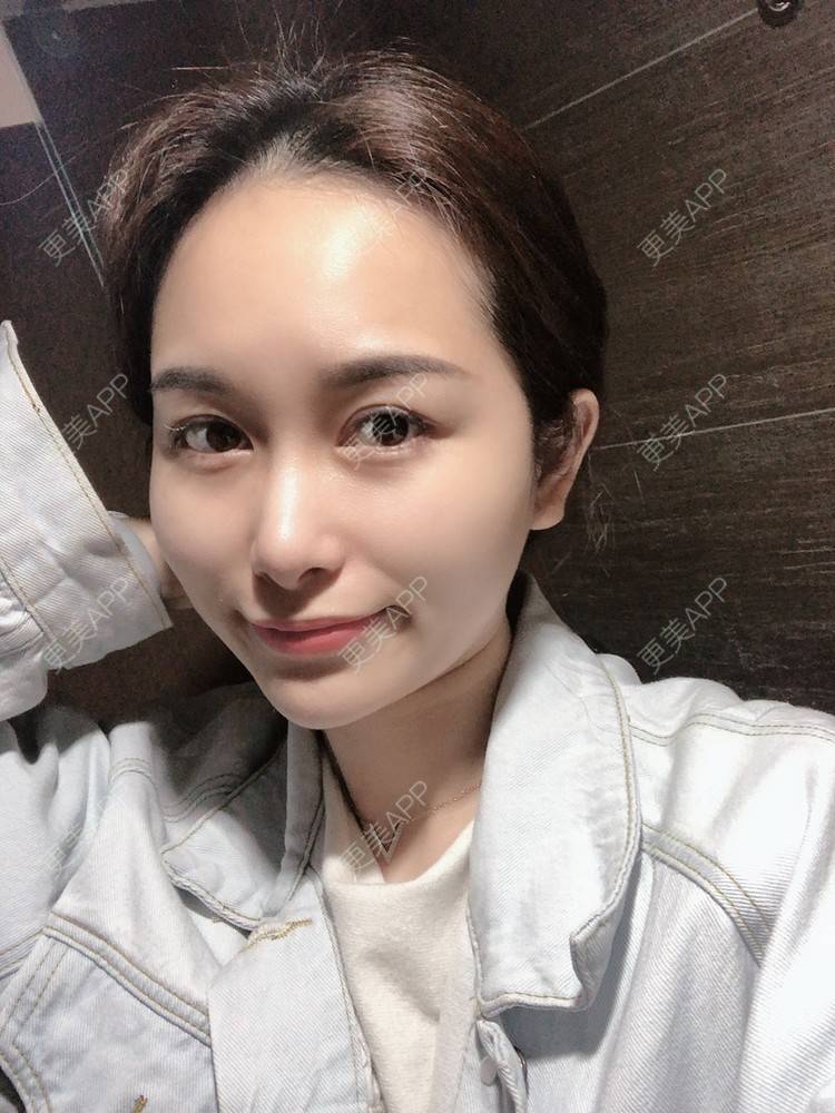 更美 - 甜心泡芙的双眼皮修复经验 | 双眼皮 | 开内眼角 | 双眼皮修复 | 全切双眼皮 | 重庆