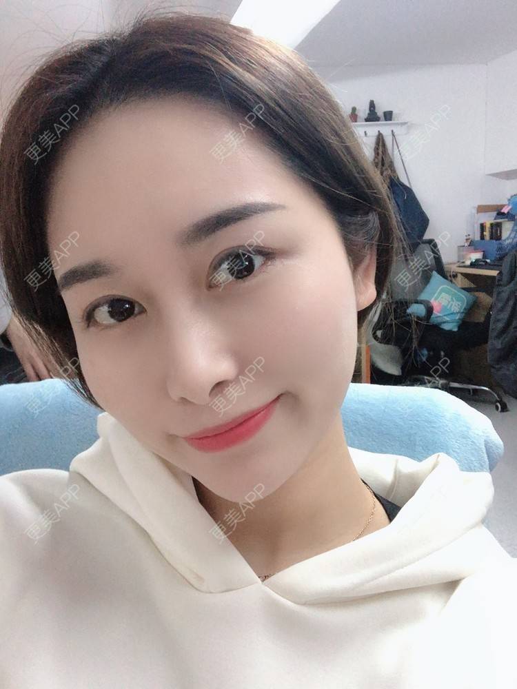 更美 - 甜心泡芙的双眼皮修复经验 | 双眼皮 | 开内眼角 | 双眼皮修复 | 全切双眼皮 | 重庆