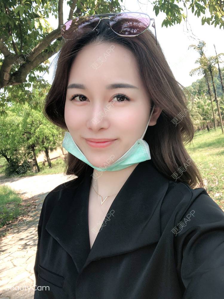 更美 - 甜心泡芙的双眼皮修复经验 | 双眼皮 | 开内眼角 | 双眼皮修复 | 全切双眼皮 | 重庆