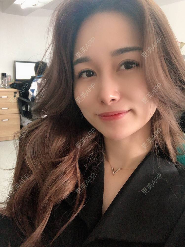 更美 - 甜心泡芙的双眼皮修复经验 | 双眼皮 | 开内眼角 | 双眼皮修复 | 全切双眼皮 | 重庆