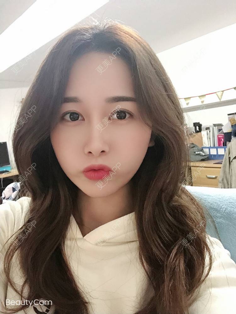 更美 - 甜心泡芙的双眼皮修复经验 | 双眼皮 | 开内眼角 | 双眼皮修复 | 全切双眼皮 | 重庆