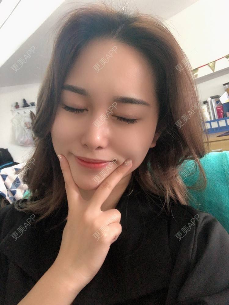 更美 - 甜心泡芙的双眼皮修复经验 | 双眼皮 | 开内眼角 | 双眼皮修复 | 全切双眼皮 | 重庆