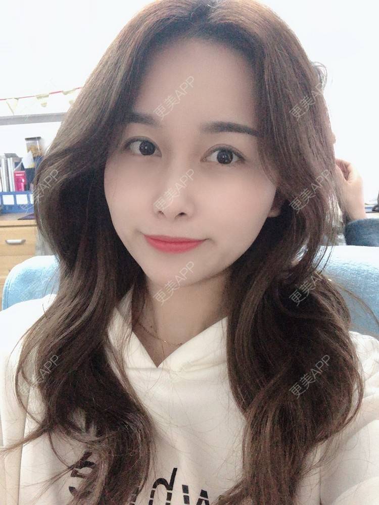 更美 - 甜心泡芙的双眼皮修复经验 | 双眼皮 | 开内眼角 | 双眼皮修复 | 全切双眼皮 | 重庆