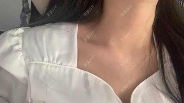 更美 - 更美用户Aji00HkTQE的玻尿酸颈纹经验 | 玻尿酸颈纹