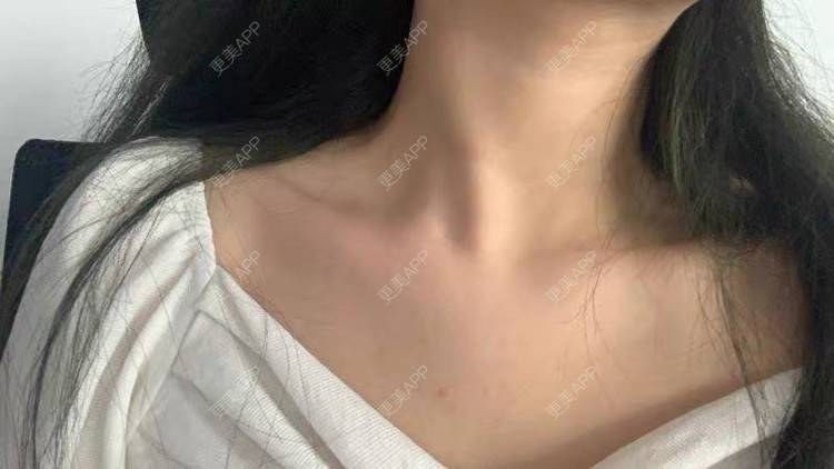 更美 - 更美用户Aji00HkTQE的玻尿酸颈纹经验 | 玻尿酸颈纹