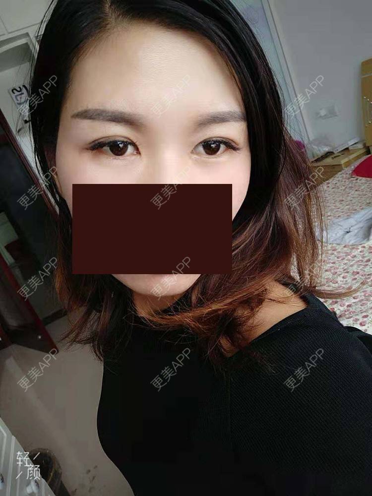 更美 - 杨丽 医生的双眼皮经验 | 双眼皮