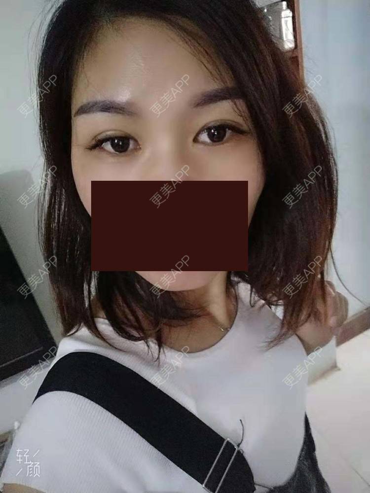 更美 - 杨丽 医生的双眼皮经验 | 双眼皮