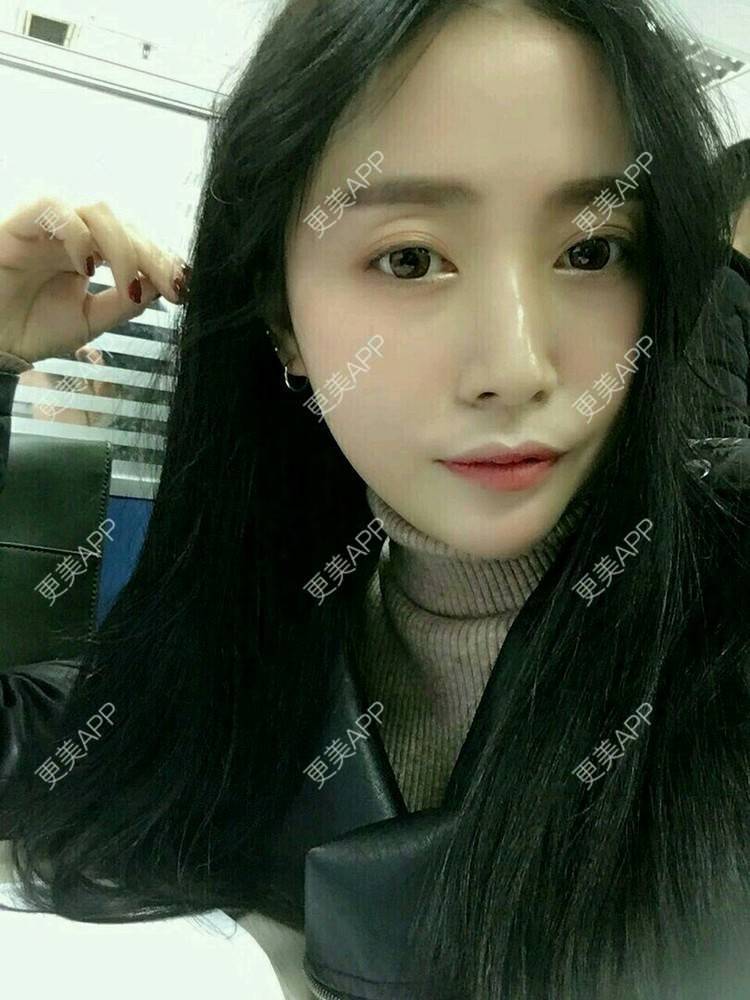更美 - 心中始终有你的玻尿酸下巴经验 | 玻尿酸下巴 | 硅胶垫下巴 | 膨体垫下巴 | 缩下巴 | 成都