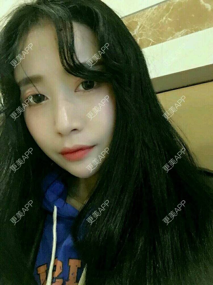 更美 - 心中始终有你的玻尿酸下巴经验 | 玻尿酸下巴 | 硅胶垫下巴 | 膨体垫下巴 | 缩下巴 | 成都