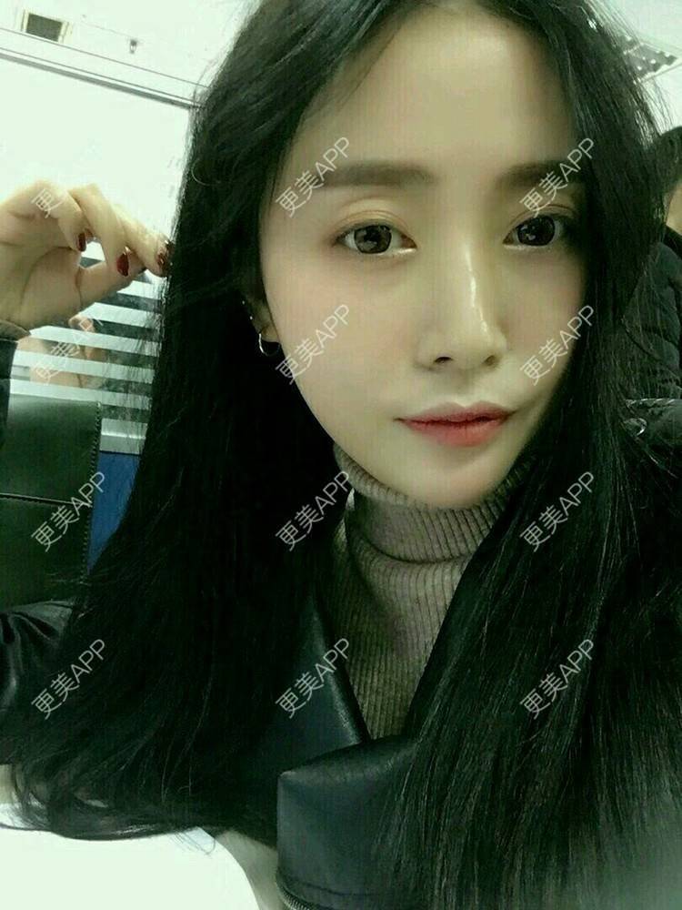 更美 - 心中始终有你的玻尿酸下巴经验 | 玻尿酸下巴 | 硅胶垫下巴 | 膨体垫下巴 | 缩下巴 | 成都
