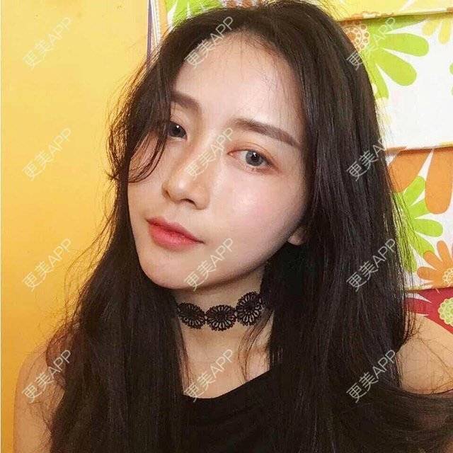 更美 - 心中始终有你的玻尿酸下巴经验 | 玻尿酸下巴 | 硅胶垫下巴 | 膨体垫下巴 | 缩下巴 | 成都