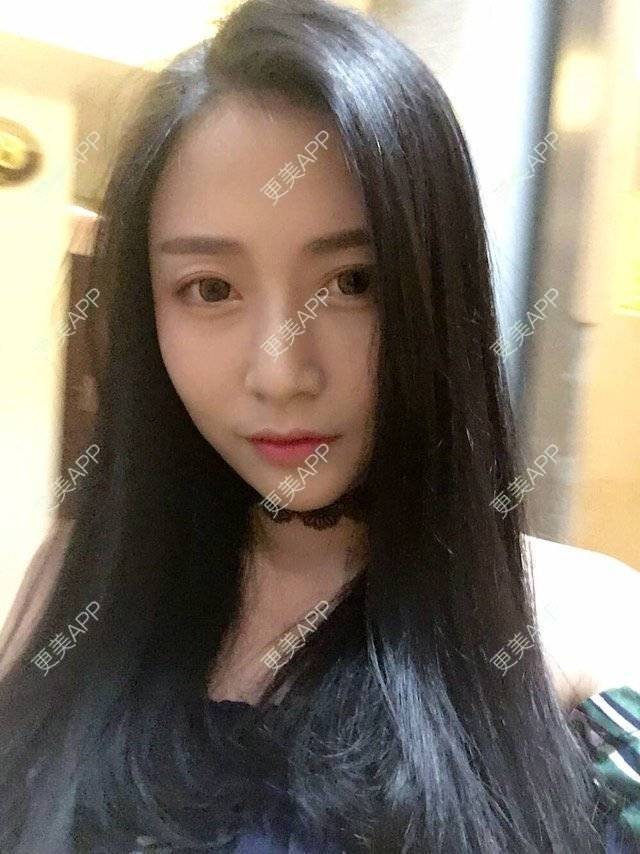 更美 - 心中始终有你的玻尿酸下巴经验 | 玻尿酸下巴 | 硅胶垫下巴 | 膨体垫下巴 | 缩下巴 | 成都