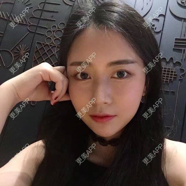 更美 - 心中始终有你的玻尿酸下巴经验 | 玻尿酸下巴 | 硅胶垫下巴 | 膨体垫下巴 | 缩下巴 | 成都