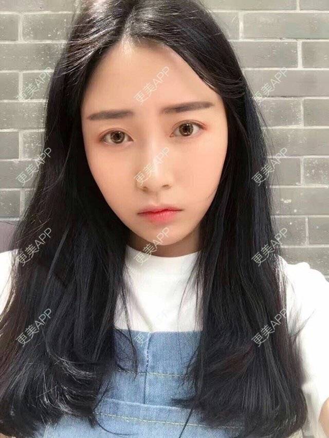 更美 - 心中始终有你的玻尿酸下巴经验 | 玻尿酸下巴 | 硅胶垫下巴 | 膨体垫下巴 | 缩下巴 | 成都