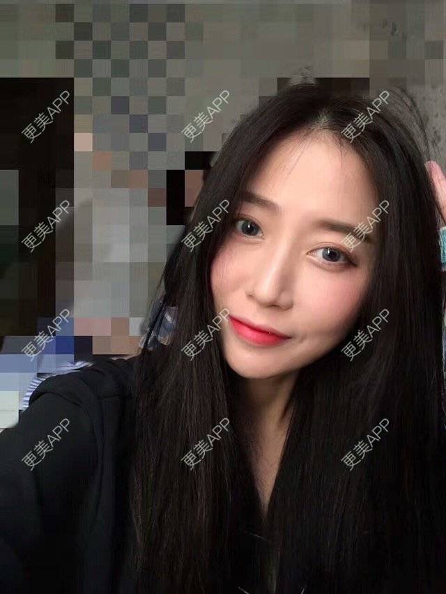 更美 - 心中始终有你的玻尿酸下巴经验 | 玻尿酸下巴 | 硅胶垫下巴 | 膨体垫下巴 | 缩下巴 | 成都