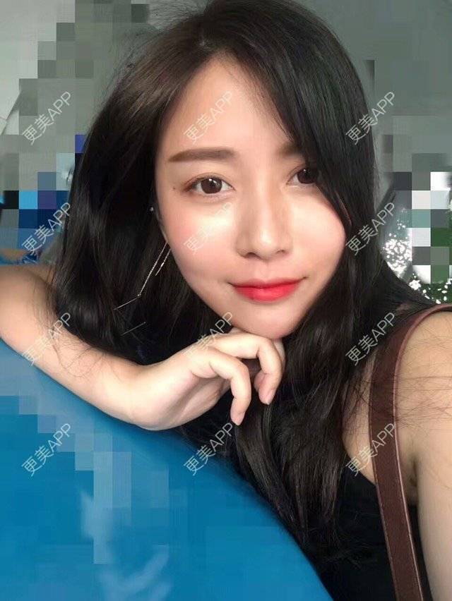 更美 - 心中始终有你的玻尿酸下巴经验 | 玻尿酸下巴 | 硅胶垫下巴 | 膨体垫下巴 | 缩下巴 | 成都