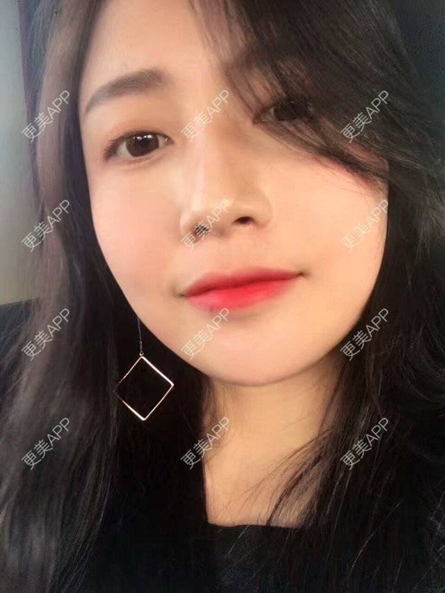 更美 - 心中始终有你的玻尿酸下巴经验 | 玻尿酸下巴 | 硅胶垫下巴 | 膨体垫下巴 | 缩下巴 | 成都