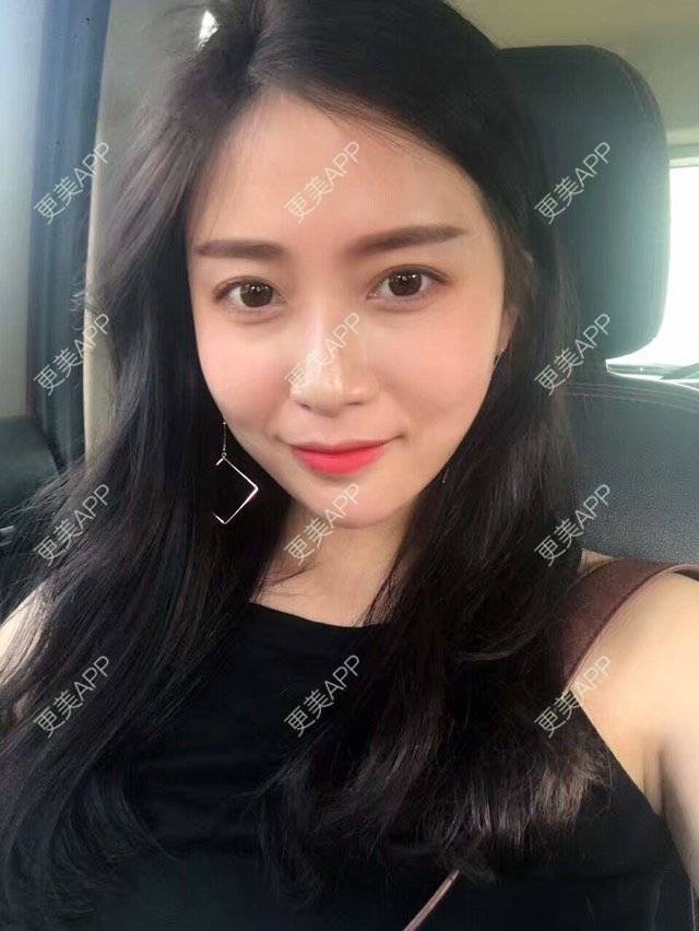 更美 - 心中始终有你的玻尿酸下巴经验 | 玻尿酸下巴 | 硅胶垫下巴 | 膨体垫下巴 | 缩下巴 | 成都