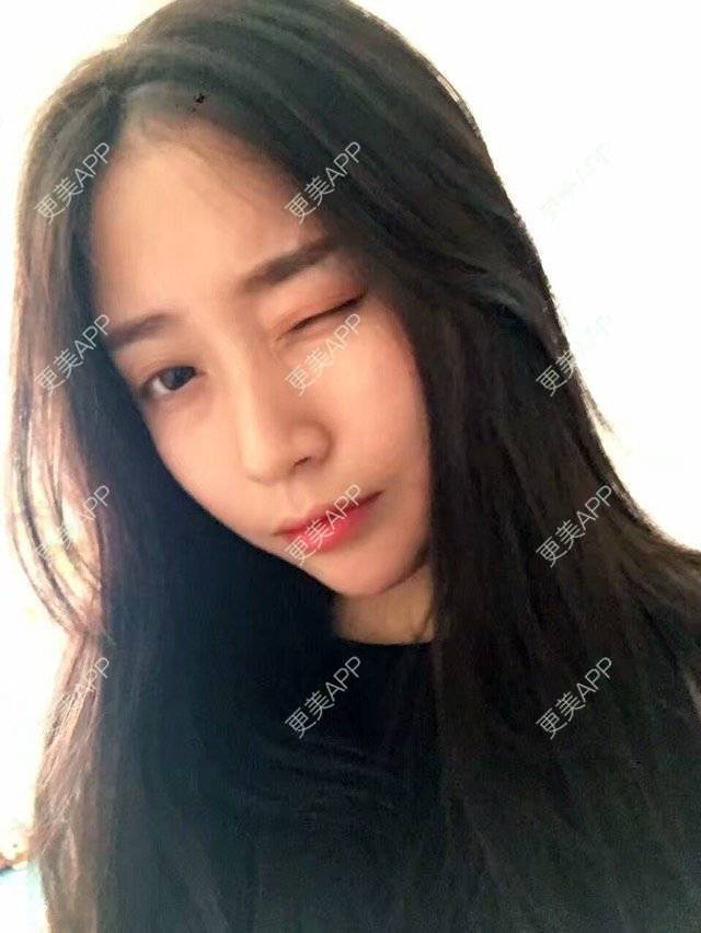 更美 - 心中始终有你的玻尿酸下巴经验 | 玻尿酸下巴 | 硅胶垫下巴 | 膨体垫下巴 | 缩下巴 | 成都