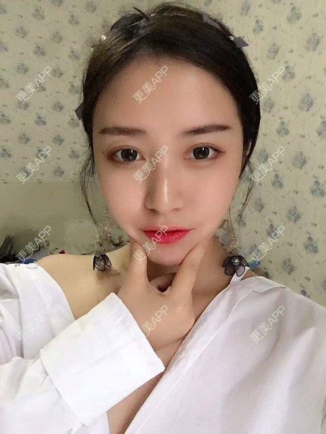 更美 - 心中始终有你的玻尿酸下巴经验 | 玻尿酸下巴 | 硅胶垫下巴 | 膨体垫下巴 | 缩下巴 | 成都