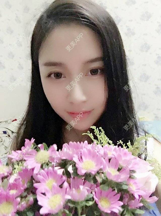 更美 - 心中始终有你的玻尿酸下巴经验 | 玻尿酸下巴 | 硅胶垫下巴 | 膨体垫下巴 | 缩下巴 | 成都
