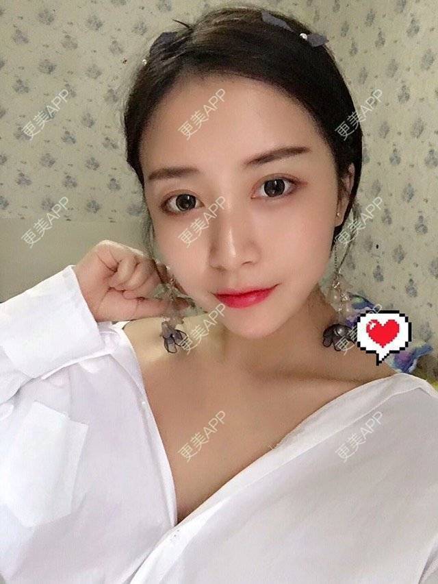 更美 - 心中始终有你的玻尿酸下巴经验 | 玻尿酸下巴 | 硅胶垫下巴 | 膨体垫下巴 | 缩下巴 | 成都