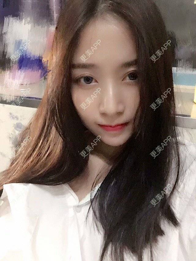 更美 - 心中始终有你的玻尿酸下巴经验 | 玻尿酸下巴 | 硅胶垫下巴 | 膨体垫下巴 | 缩下巴 | 成都
