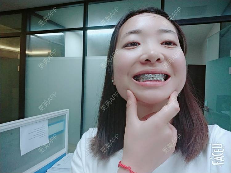 更美 - 橙子Jiang的牙齿矫正经验 | 牙齿矫正 | 成都