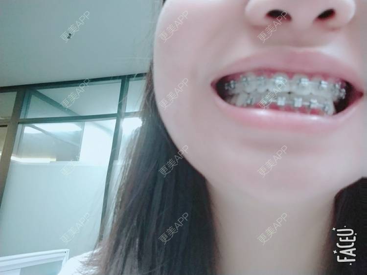 更美 - 橙子Jiang的牙齿矫正经验 | 牙齿矫正 | 成都