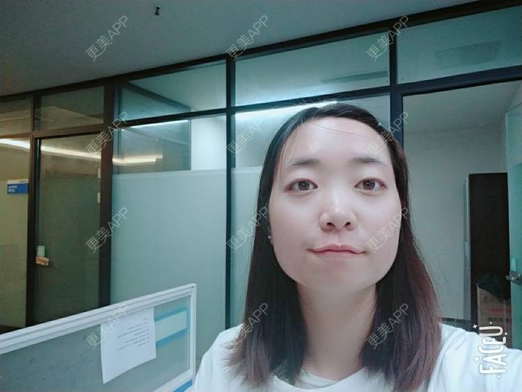 更美 - 橙子Jiang的牙齿矫正经验 | 牙齿矫正 | 成都