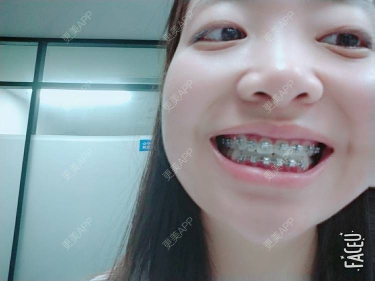 更美 - 橙子Jiang的牙齿矫正经验 | 牙齿矫正 | 成都