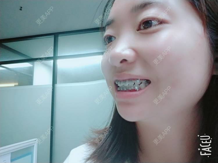 更美 - 橙子Jiang的牙齿矫正经验 | 牙齿矫正 | 成都