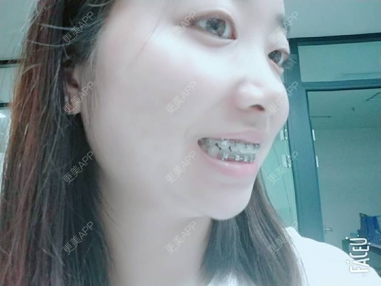 更美 - 橙子Jiang的牙齿矫正经验 | 牙齿矫正 | 成都