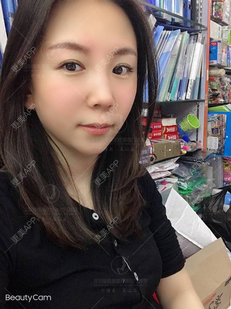 更美 - 杨宝宝😊啊的埋线提升经验 | 埋线提升 | 深圳